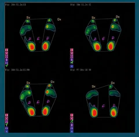 Schermata software: test stabilometrico con acquisizioni a occhi aperti e occhi chiusi